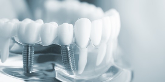 Ansicht eines durchsichtigen Kiefermodells mit eingesetztem Implantat